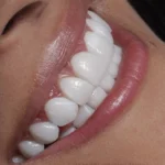 limpieza dental