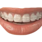 ortodoncia en barcelona