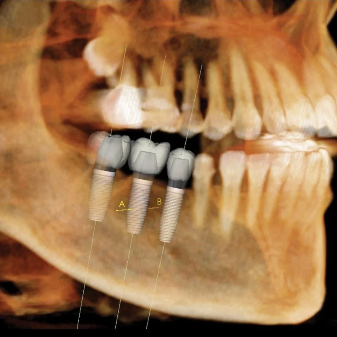 implantes dentales barcelona