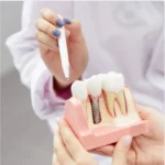 implantes dentales barcelona