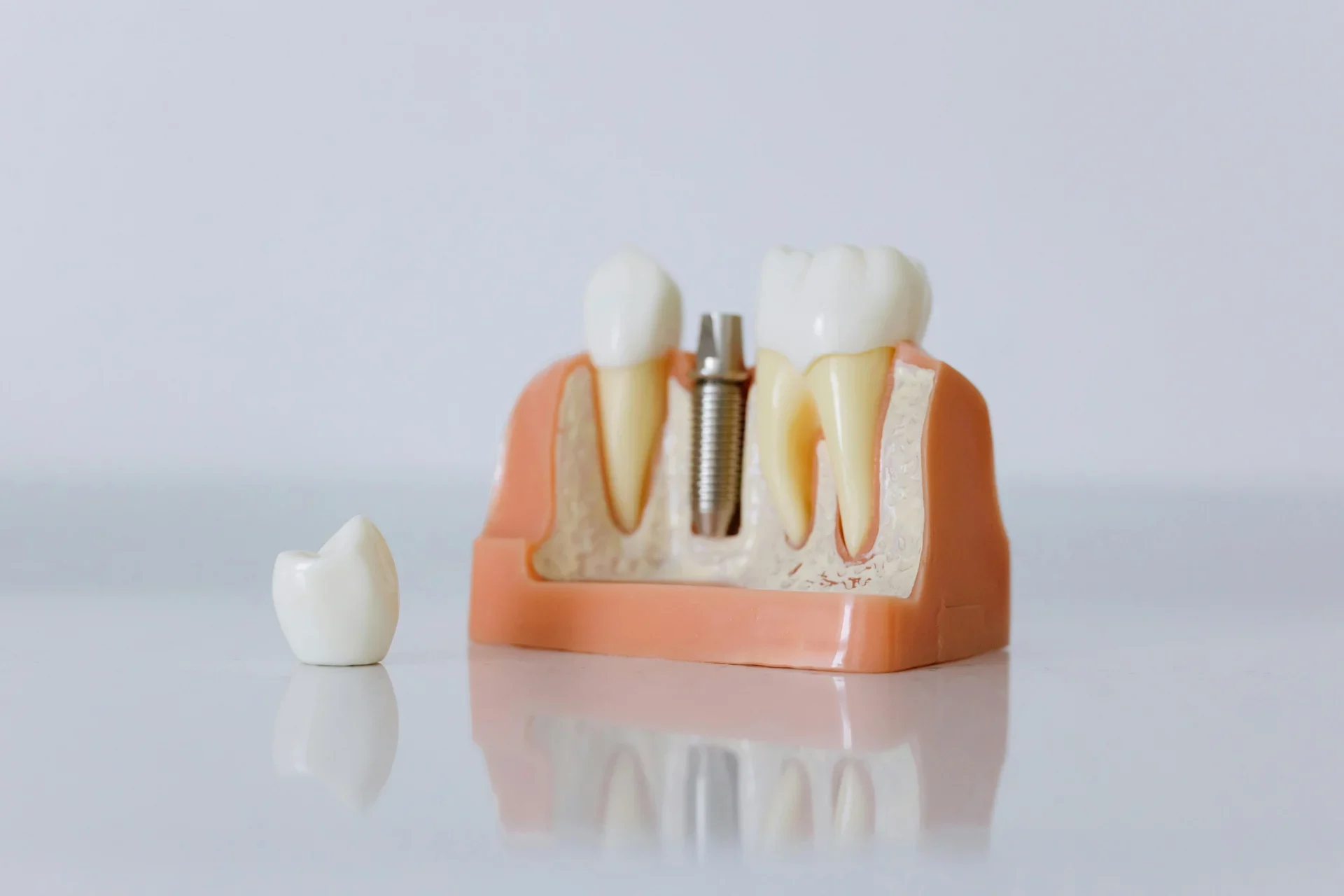 Primer plano de un modelo de implante dental con dientes artificiales y estructura maxilar.