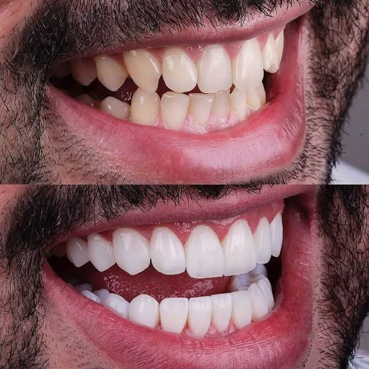 Carillas e.max antes y después en Barcelona