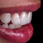 Carillas de porcelana de aspecto natural en Barcelona
