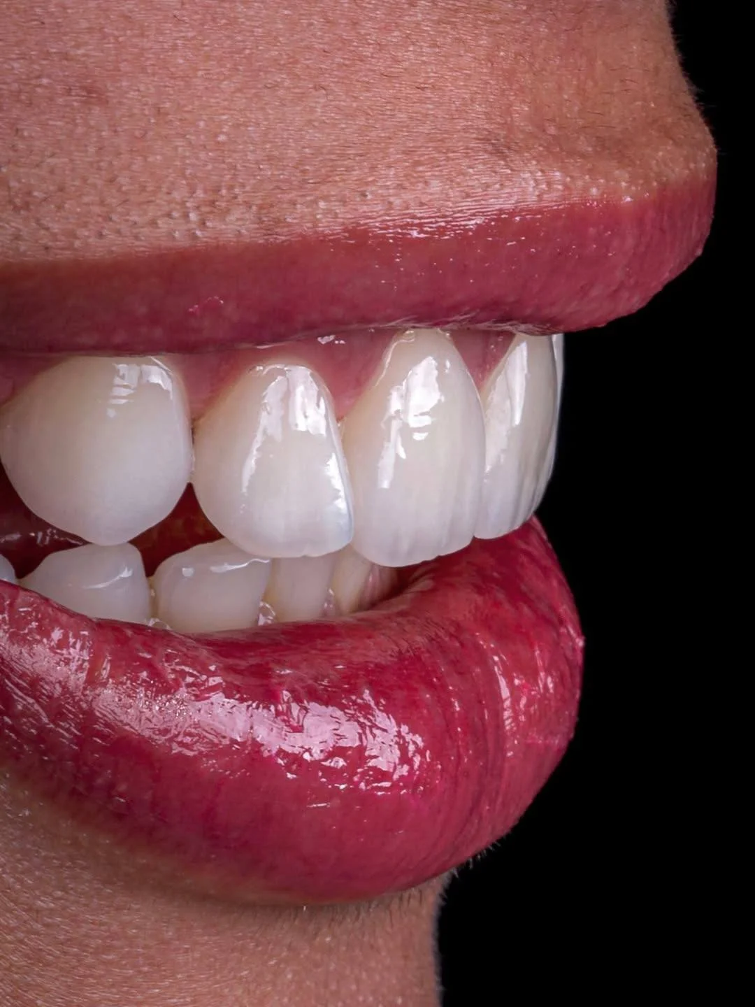 Carillas de porcelana de aspecto natural en Barcelona