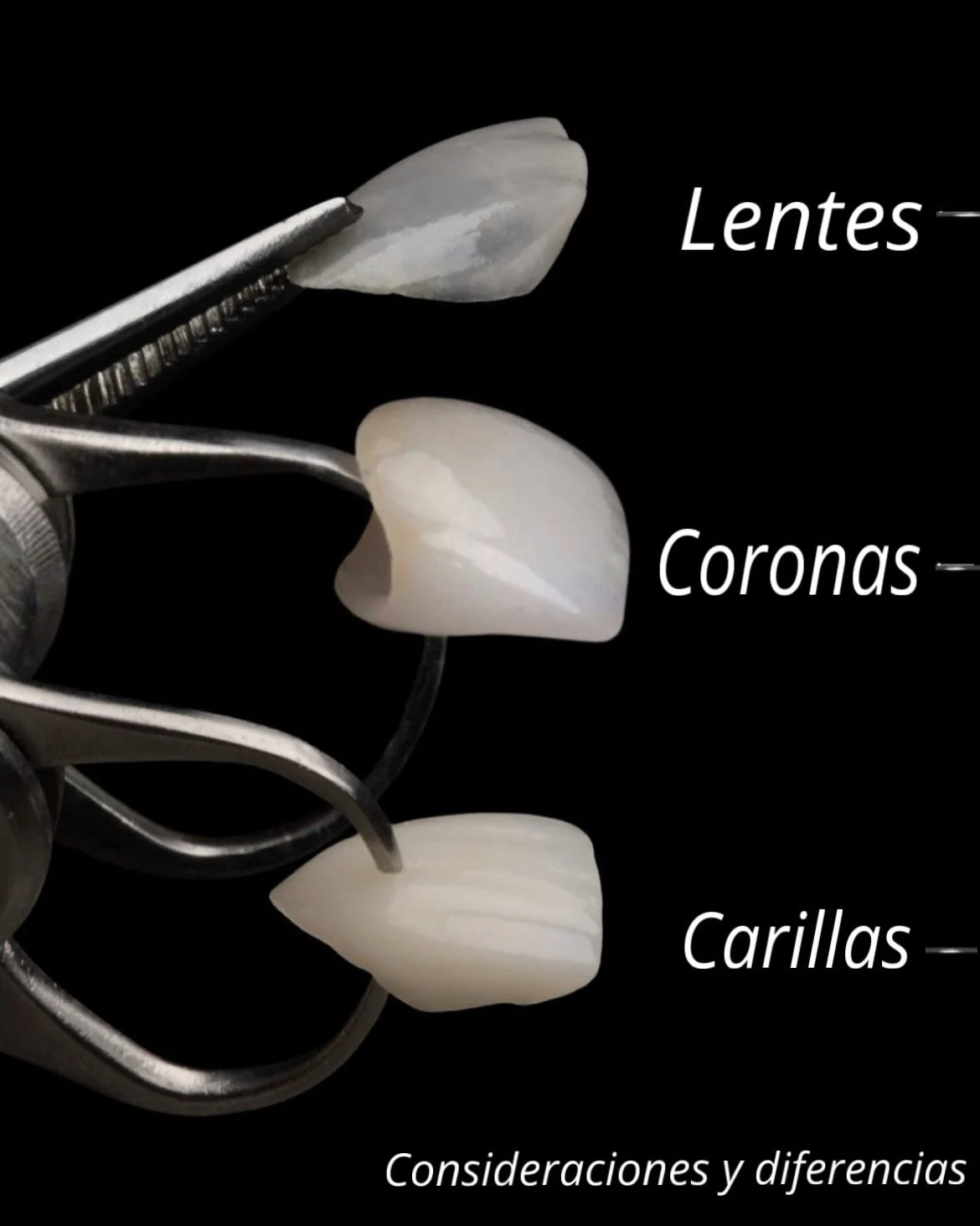 Lentes dentales, coronas y carillas de porcelana: diferencias