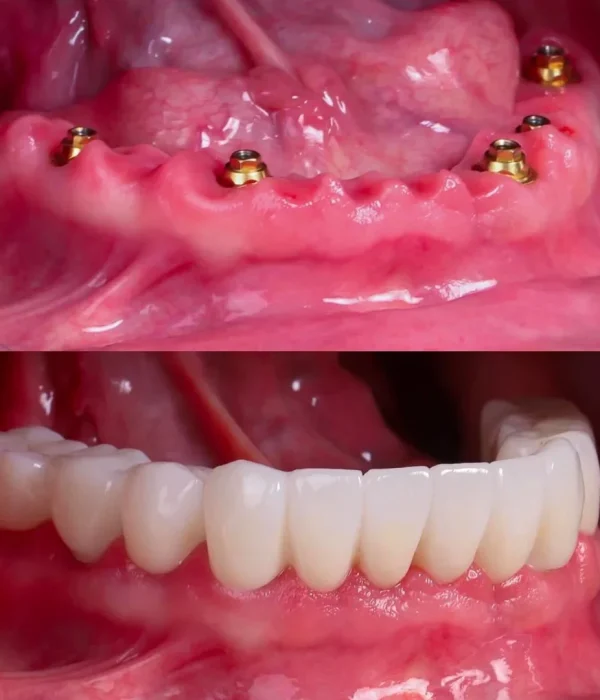 implantes dentales