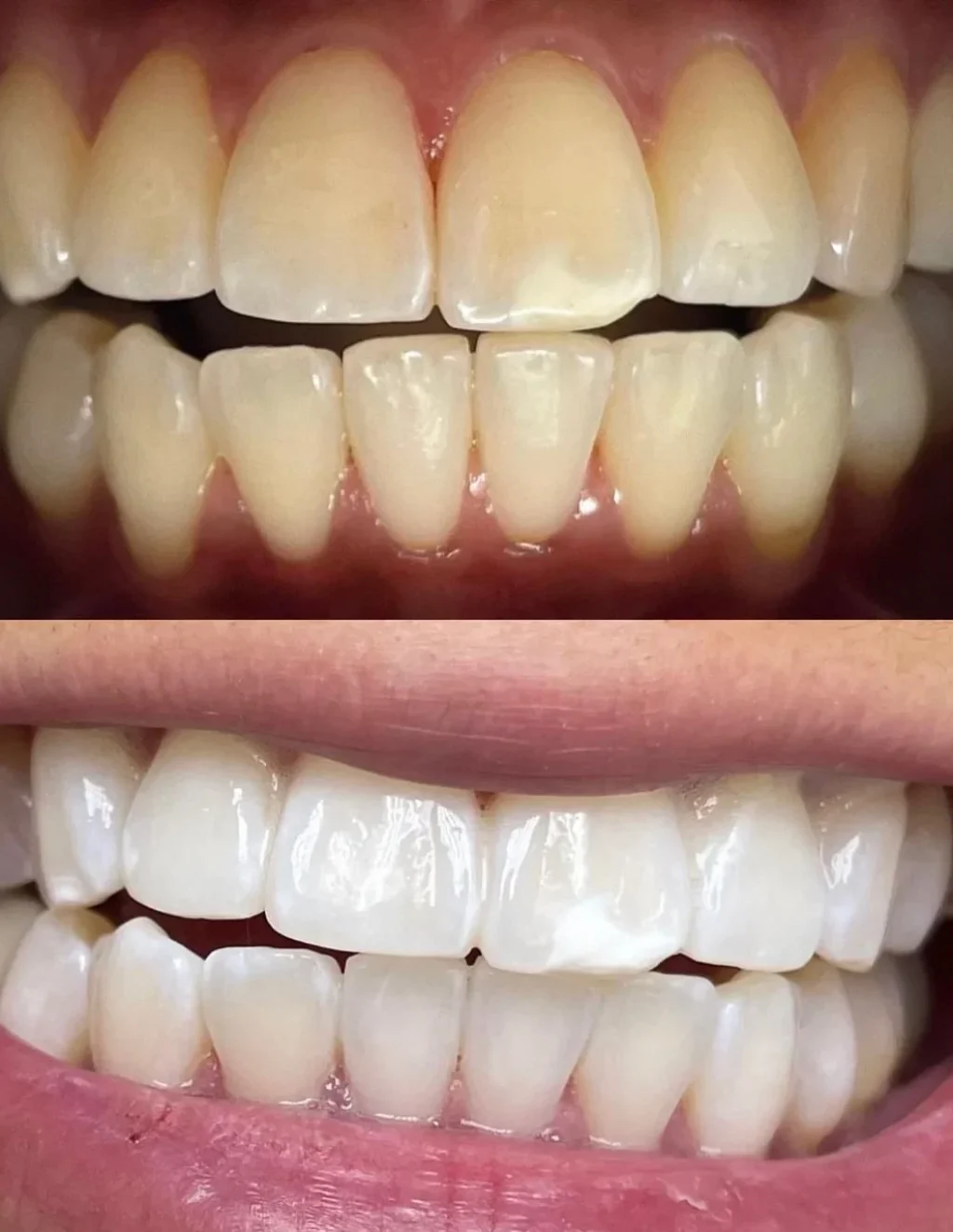 IMG_5824 blanqueamiento dental en barcelona