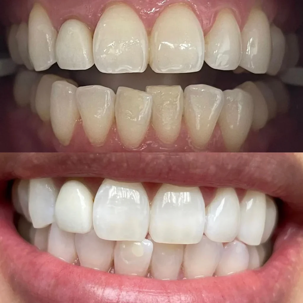 IMG_5826 blanqueamiento dental en barcelona